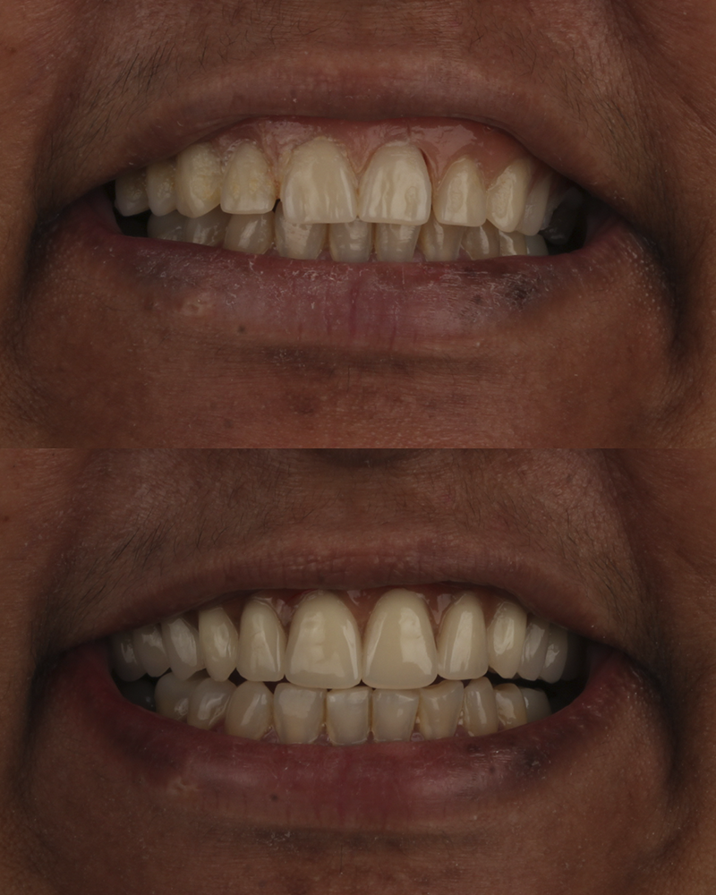Procedimento de implante dentário