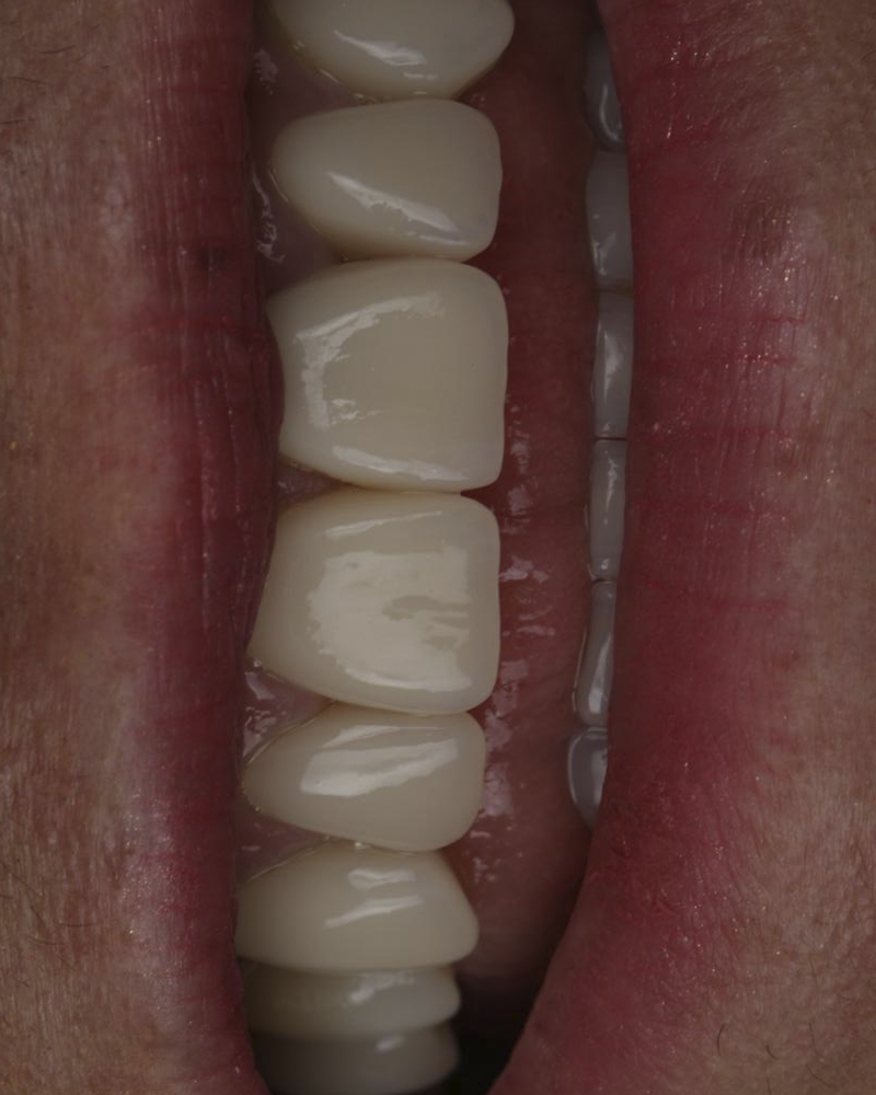 Sorriso com lentes de contato dental